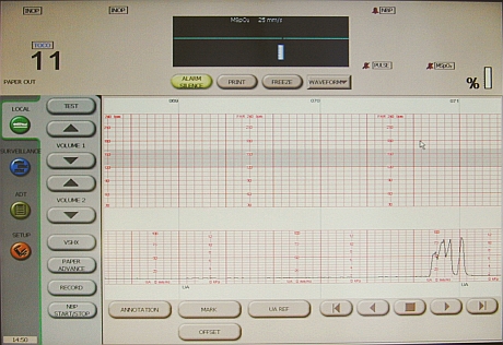  Corometrix  2120